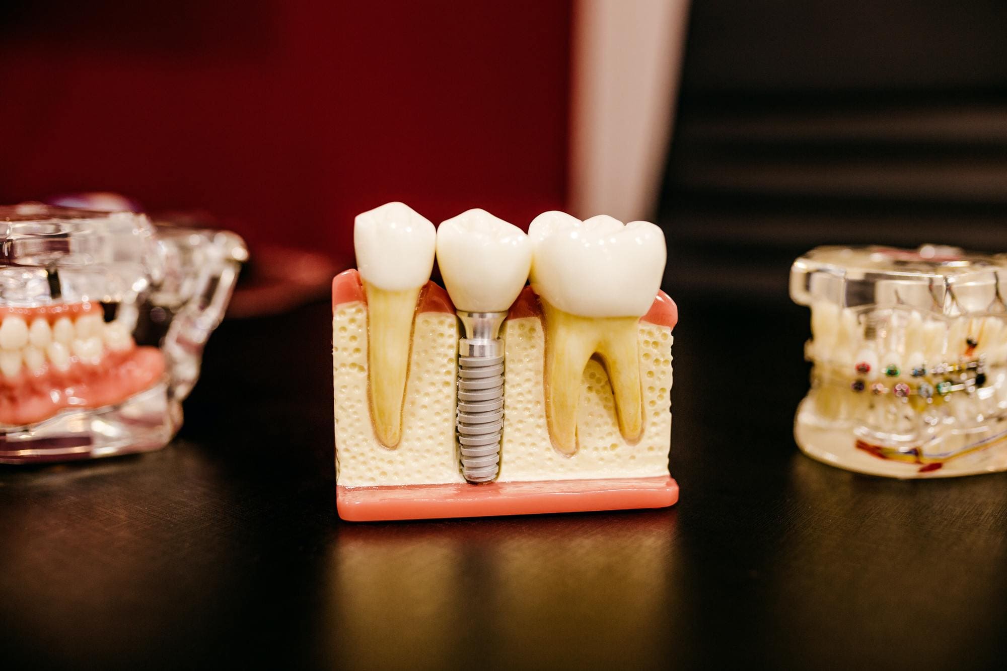 Interventi di implantologia dentale
